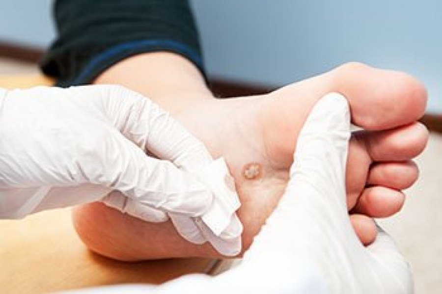 What Is a Plantar Wart?